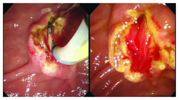 Complete endoscopic sphincterotomy was performed.