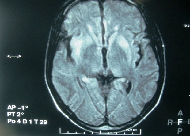 Brain MRI showing focal hyperintensity of the right sub-cortico-frontal region on FLAIR image