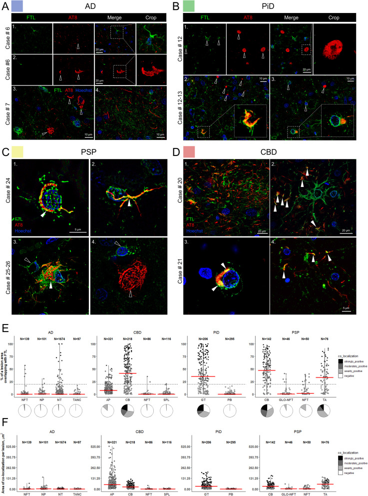 FTL co-localizes with glial tau pathology in cortical tissue from primary tauopathy cases. A FTL was highly enriched in cells with a microglia-like morphology in AD tissue (series 1) and did not co-localize NFTs (series 2–3) or other AD neuritic pathology (series 4). B PiD neuronal inclusions were negative for FTL (series 1–3, unfilled arrowheads). Glial inclusions located in the white matter were markedly co-localized with FTL (series 2–3). C PSP CBs (series 1) and some TAs (series 2–3) were positive for FTL and AT8, while GLO-NFTs did not associate with FTL signal (series 4). D CBD APs showed strong co-localization within the corona of tau positive distal extensions with FTL decorating various sizes of APs (series 1). In most cases, FTL-positive cells were often found close to the center of developing APs (series 2). FTL also co-localized with CBs (series 3), and some NTs (series 4). E Quantification of FTL-positive phospho-tau lesions from n = 3 cases/tauopathy showing the relative area of overlap between AT8 and FTL in tauopathy lesions. Modified violin plots with data points show individual lesions plotted against relative overlap area. Lesions are categorized into co-localization categories based on their relative area of overlap. Red lines indicate median values. Pie charts underneath the violin plots illustrate the relative proportions of lesions with different degrees of co-localization. F Quantification of absolute areas of overlap between AT8 and FTL per individual tauopathy lesions from n = 3 cases/tauopathy, Modified violin plot with data points show individual lesions plotted against absolute overlap area. Lesions are categorized into co-localization categories as in E. Red lines indicate median values. Abbreviations: AD, Alzheimer’s disease; PiD, Pick’s disease; CBD, corticobasal degeneration; PSP, progressive supranuclear palsy; NFTs, neurofibrillary tangles; TANCs, tangle-associated neuritic clusters; APs, astrocytic plaques; CBs, coiled bodies; PBs, Pick bodies; GT, glial tau; NTs, neuropil threads; NP, neuritic plaque; SPL, small phospho-tau lesions; TA, tufted astrocytes; GLO-NFT, globose NFTs