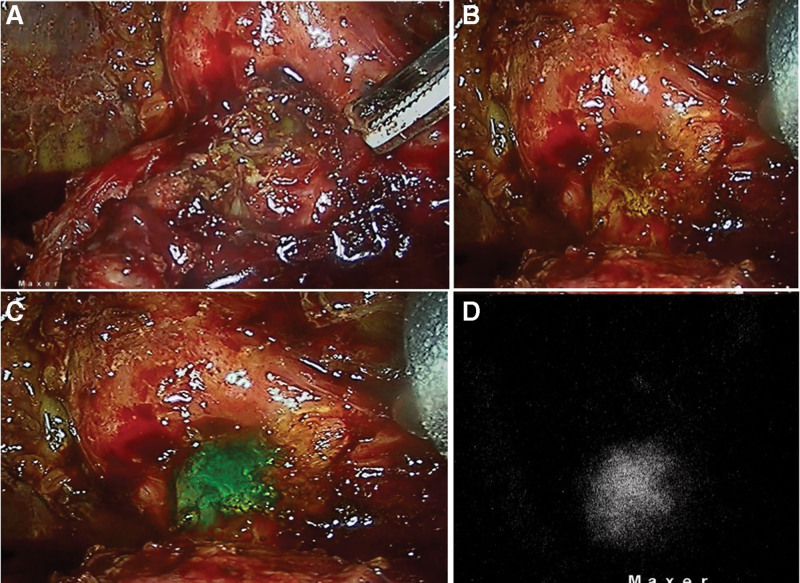 In a patient undergoing Laparoscopic CBD exploration, (a) Pure laparoscopic view during dissection of difficult hepatocystic triangle; (b) ICGF demonstrating cystic duct and CBD junction and the cleared supraduodenal CBD in preparation for choledochotomy; (c) Supraduodenal choledochotomy showing fluorescent bile exiting the choledochotomy; (d) Trans-cystic duct instillation of ICG demonstrating no fluorescent leak from choledochotomy closure site. CBD = common bile duct, ICGF = ICG fluorescence.
