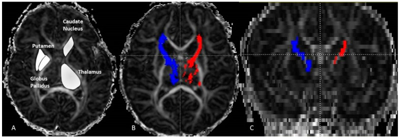 Axial fractional anisotropy (FA) image (A) displaying the ROI manual drawing on the thalamus, caudate-nucleus, putamen and globus pallidus. On the (B) image the result of fiber tracking of the left (red) and right (blue) thalamo-cortical pathways. The same pathways are displayed in the coronal plane (C). These were performed on a neonate girl (GA = 43 weeks + 3 days).