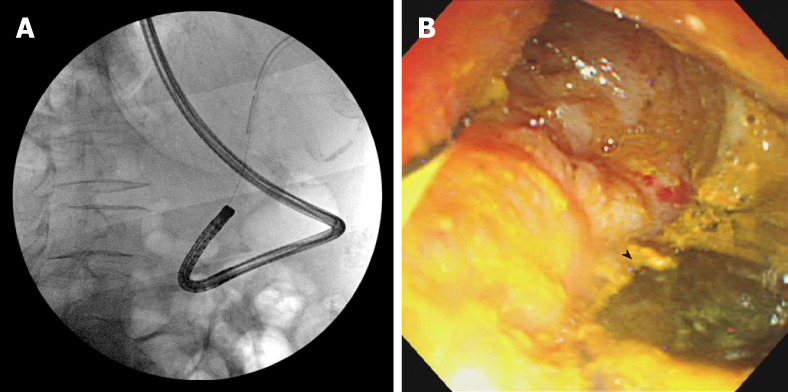 Images of direct peroral cholangioscopy by nasal endoscope with rendezvous technique. A: Cholangiography images of insertion of nasal endoscope in common bile duct (CBD) by rendezvous technique; B: Direct peroral cholangioscopy image by nasal endoscope in CBD. Black arrow head shows adhered stone piece in the CBD wall.