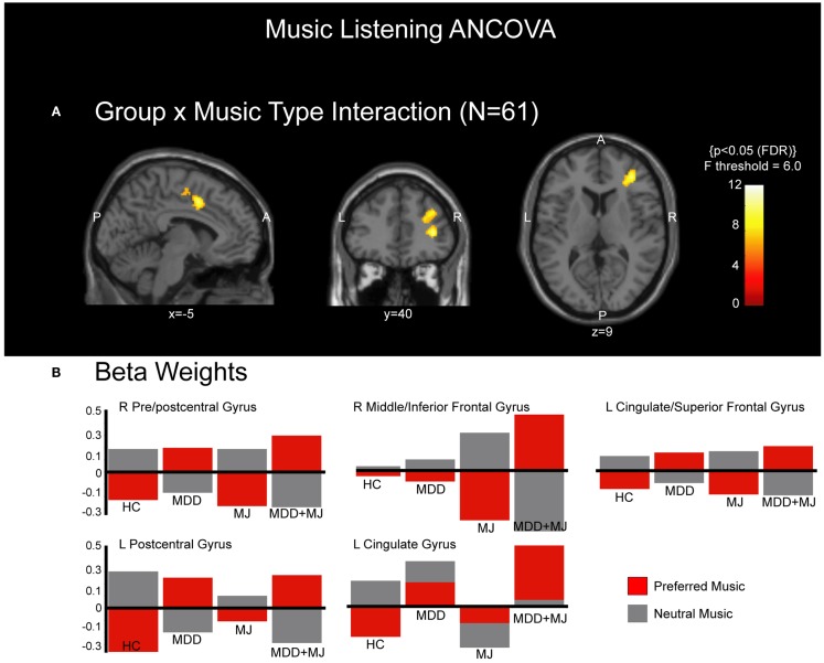 ANCOVA group × music interaction. (A) shows clusters of activated voxels in the sagittal, coronal, and transverse perspectives overlaid on a normalized T1-weighted anatomical image at MNI planes indicated. P = posterior, A = anterior, L = left, R = right. (B) shows the beta weights associated with each identified cluster that met statistical significance, separated by music type and by group.