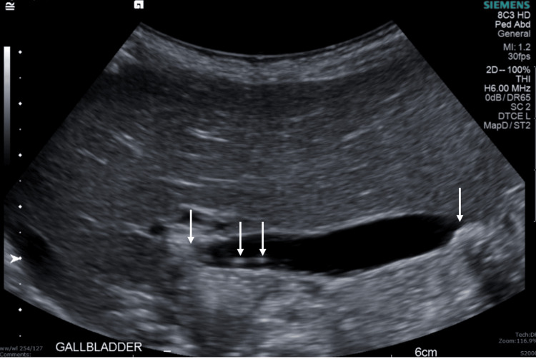 Follow-up abdominal ultrasoundFollow-up abdominal ultrasound (gallbladder view) showing interval resolution of previously seen intra- and extrahepatic biliary duct dilatation and cholelithiasis without cholecystitis, including a 6 mm gallstone in the neck of the gallbladder.