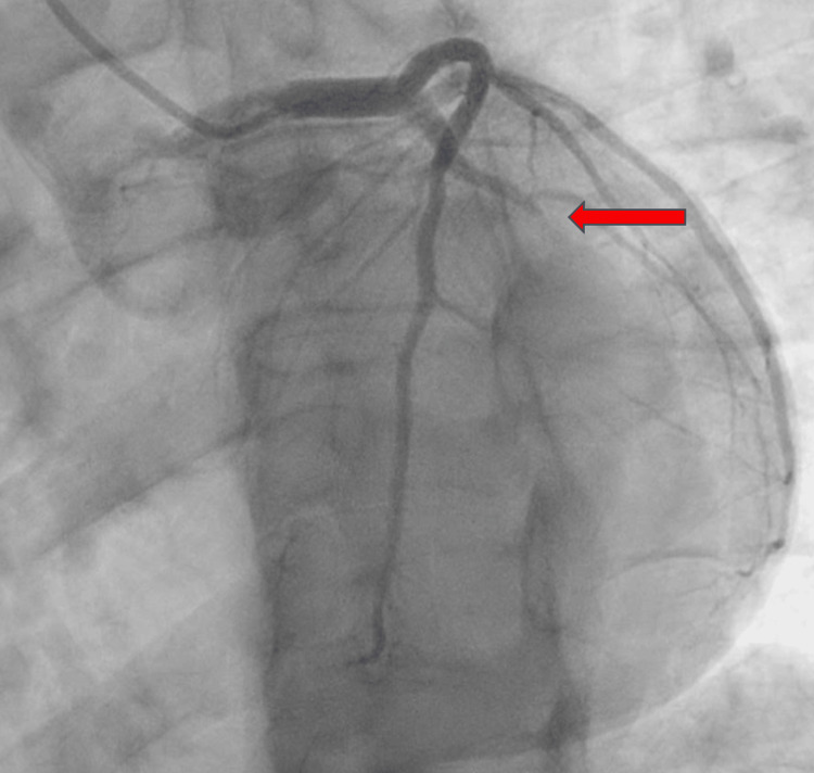 LAO caudal view pre-PCI showing total occlusion to the mid-left circumflex artery (red arrow)LAO: left anterior oblique; PCI: percutaneous coronary intervention