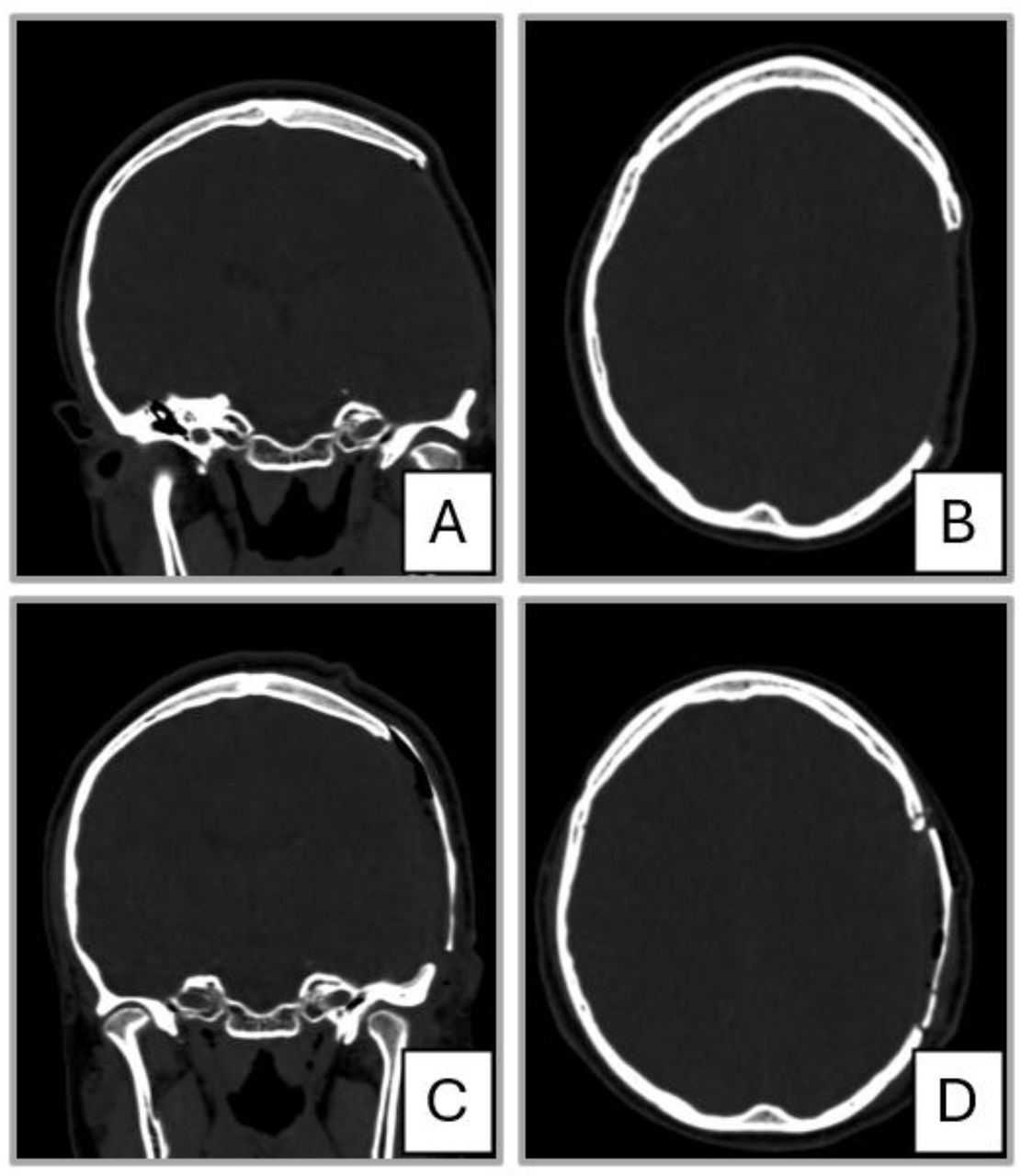Preoperative and postoperative CT evaluation of cranial reconstruction.(A) Preoperative coronal CT demonstrating the cranial defect.(B) Preoperative axial CT showing the extent of the defect.(C) Postoperative coronal CT demonstrating restoration of cranial contour.(D) Postoperative axial CT showing adequate implant positioning.