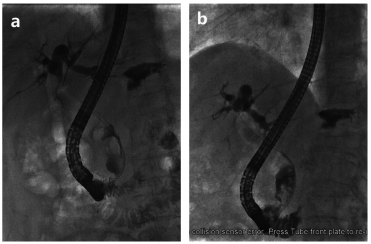 a, b. ERCP showing the size of CBD stones changed before (a) and after (b) biliary stent placement