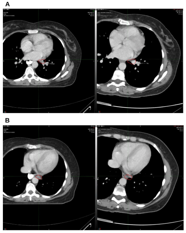 The third follow-up at 9 months off. On the left, CT from October 2019, pre-radiation therapy treatment; on the right, CT from July 2020. (A) Hilar lymph node; (B) left para-aortic lymph node. The indicated region highlights the boundary of the treated target.