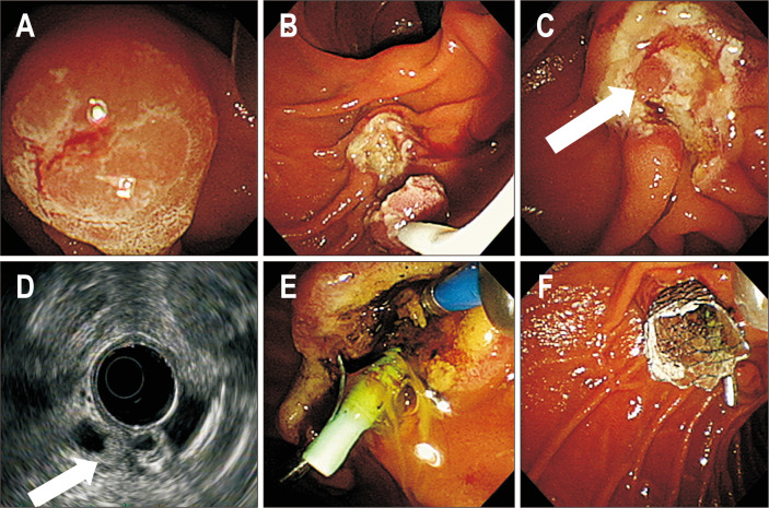 Intraductal-radiofrequency ablation procedure. (A) Endoscopic view showing ampullary tubular adenoma with high-grade dysplasia confirmed in a previous pathology examination. (B) Endoscopic image showing endoscopic snare papillectomy, which was performed for resection of the ampullary adenoma. (C) Endoscopic view showing nodular lesions in the common bile duct (CBD) orifice (white arrow). (D) Radial endoscopic ultrasound showing a 6-mm-sized echogenic mass in the far distal CBD (white arrow). (E) Endoscopic image showing whitening change of the CBD orifice during intraductal-radiofrequency ablation. (F) Endoscopic image showing placement of the metallic biliary stent and plastic pancreatic stent.