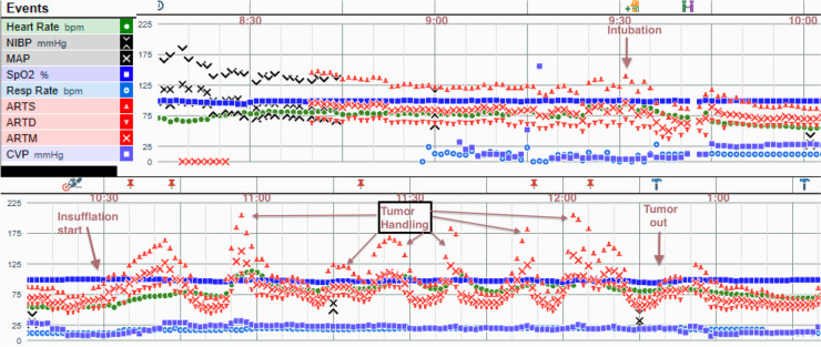 Intraoperative record during the patient’s adrenalectomy. Hypertensive episodes were observed with increased abdominal pressure from insufflation alone, then later during tumor handling, confirming that physical compression of the tumor from indirect pressure caused surges in blood pressure, even with the patient under a general anesthetic