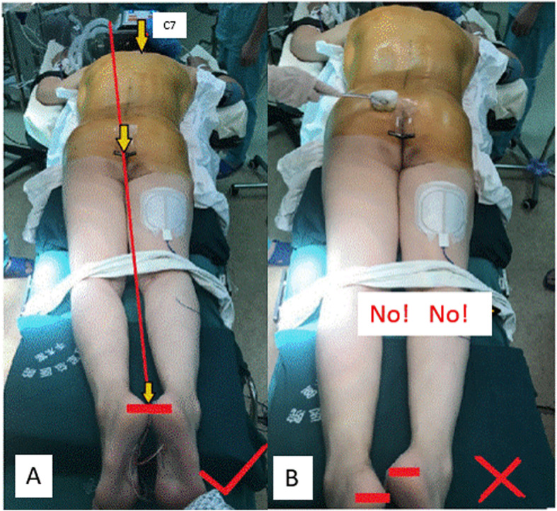 a Establishing lower body part aligner. b A common mistake during patient’s positioning