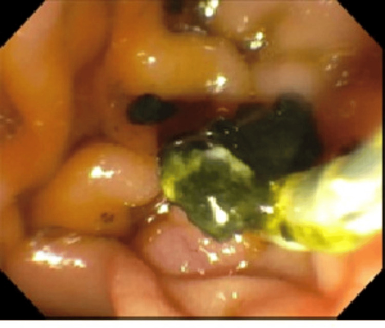Endoscopic retrograde cholangiopancreatography (ERCP) showing extraction of stones from the common bile duct (CBD) after sphincterotomy