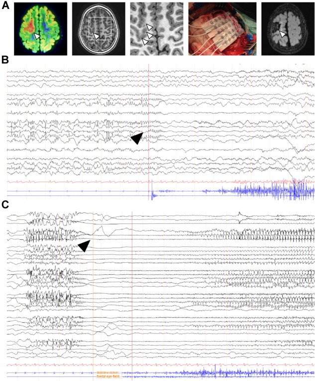 EEG characterization of a representative FCD case subject to surgery. (A) FDG-PET scan co-registered with 3T MRI of a 5-year-old child affected by a “malignant rolandic epilepsy” with daily motor seizures and Epilepsia Partialis Continua. Hypermetabolic FDG-PET focus (arrowheads). Small focal cortical dysplasia involving the left rolandic region and superior frontal gyrus (arrowhead) and MRI 1 year after epilepsy surgery. (B,C) Scalp and intracraneal EEG recording, respectively, of the previous patient, using a combination of subdural electrodes and depth electrodes, prior resection of the epileptogenic zone. Arrowheads, indicate epileptiform activity.