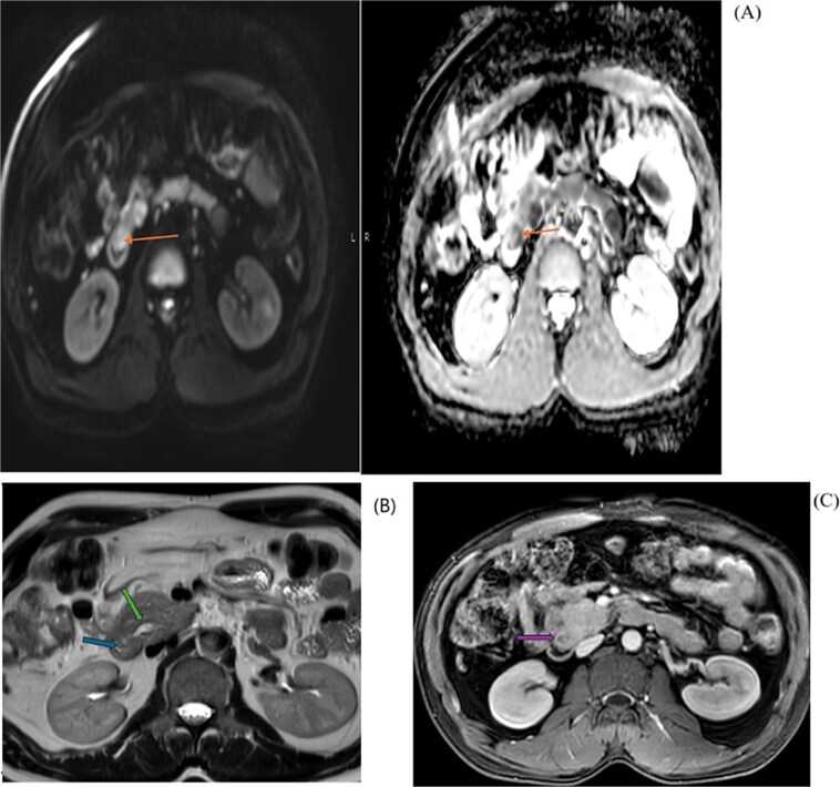MRI diffusion/ADC map (A) shows restriction pattern of the periampullary lesion reflecting bright signal on diffusion and dark signal on ADC map. MRI axial T2 haste image at the level periampullary region (B) shows rounded isointense lesion. And post IV contrast axial MRI image (C) shows hypo enhancement of the peri-ampullary mass.