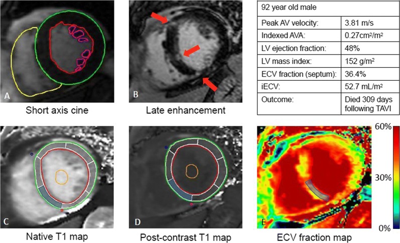 Comprehensive CMR assessment in valvular heart disease: ventricular function (A), late gadolinium assessment (B), native T1 mapping (C), post-contrast T1 mapping (D) and extracellular volume of distribution map (E). Reproduced with permission from Everett et al25