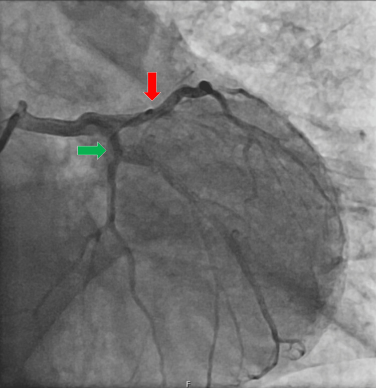 Cardiac catheterization findings.The left main coronary artery had no lesions. The left anterior descending artery (red arrow) showed irregularities but no significant lesions. The circumflex artery (green arrow) had irregularities but no significant lesions. The right coronary artery (not shown) was dominant and showed no lesions. Ventriculography revealed a non-dilated left ventricle with akinesia of the mid-apical segments and basal hypercontractility, suggestive of Takotsubo syndrome. There was no mitral insufficiency.