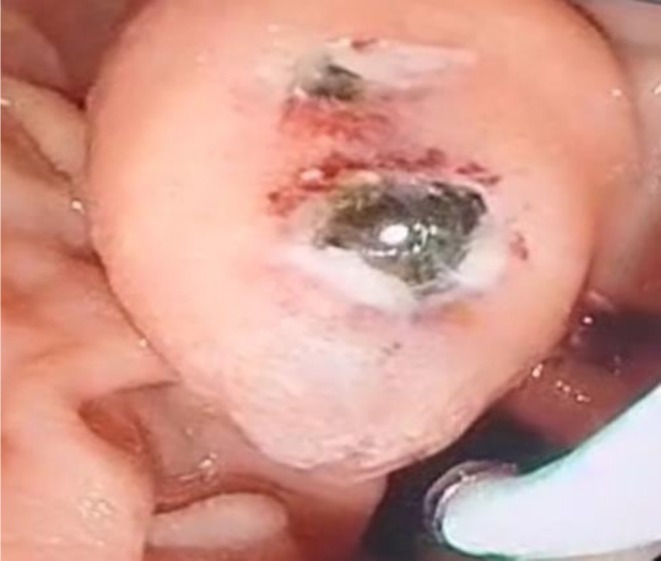 The major papilla, which is protruding into the duodenum, has the tip of a stone visible.