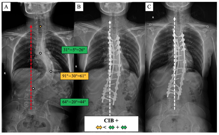 CIB+ case, 21-year-old female AdIS patient ((A): preoperation, (B): postoperation, and (C): 2-year follow-up). The main thoracic curve was corrected from 91° to 30° (61° correction). The upper thoracic curve was corrected from 31° to 5° (26° correction), and the lumbar curve was corrected from 64° to 20° (44° correction). The correction rate of the main curve was less than the compensatory curves. The coronal plane balance was improved after surgery, but no further improvement could be observed at the final follow-up.