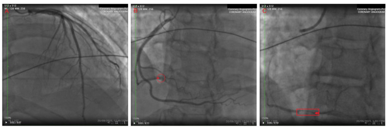 The patient’s PPCI. (A) The patient’s left coronary arteries (LAD artery and LCx artery) are angiographically normal with TIMI 3 flow. (B) TIMI grade 1 flow in the acute marginal branch 1 of the RCA with TIMI grade 4 thrombus (encircled in red with red arrow). (C) Using standard interventional technique, initial manual aspiration thrombectomy was performed (Export™ Aspiration Catheter; Medtronic plc, Minneapolis, MN, USA) with subsequent PTCA with a DCB (AGENT™ Drug-Coated Balloon; Boston Scientific, Marlborough, MA, USA) with a good angiographic result (TIMI 3 flow) and no complications (red rectangle with red arrow). DCB, drug-coated balloon; LAD, left anterior descending; LCx, left circumflex; PPCI, primary percutaneous coronary intervention; PTCA, percutaneous transluminal coronary angioplasty; RCA, right coronary artery; TIMI, Thrombolysis in Myocardial Infarction.