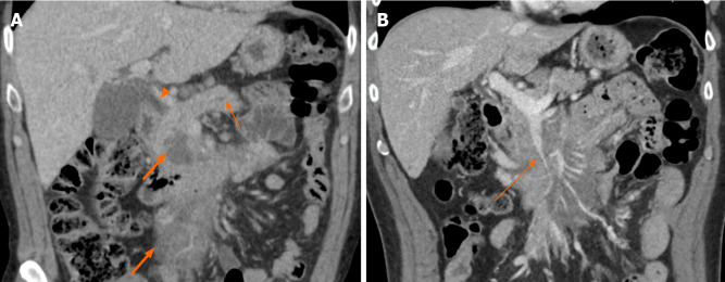 A 72-year-old male presenting with abdominal pain and jaundice. Coronal computed tomography imaging shows hypoenhancing homogenous infiltrative mass (thick arrows, A) infiltrating the mesenteric root. A: There is pancreatic duct dilation (short thin arrow) and common bile duct obstruction (arrowhead); B: There is stenosis of the superior mesenteric vein (long thin arrow) caused by the tumor.