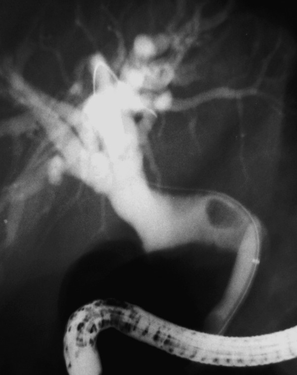 Endoscopic Papillary Balloon Dilation. Dilation of the ectopic opening with a 8 mm diameter biliary dilation balloon. Note the stone next to the balloon.