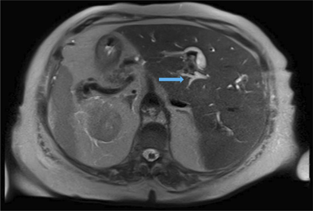 Axial magnetic resonance imaging demonstrates intrahepatic biliary tree dilatation (arrow). Transposition of the liver, spleen, and pancreas are noted.