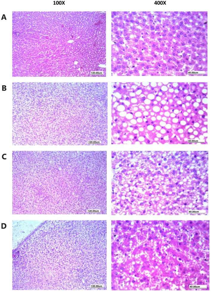 Histopathology of rat liver specimens stained with hematoxylin and eosin. (A) Sections from normal liver tissues showing preserved architecture, hepatocytes arranged in thin plates separated by patent sinusoids. Hepatocytes have having homogenous eosinophilic cytoplasm, with regular nuclei. (B) Sections from liver tissues in NASH control group showing disturbed architecture, hepatocytes arranged in thick plates with marked steatosis (macro vesicular) presented as large cytoplasmic clear regular vacuole, with obscured sinusoids in-between. Nucleus is pushed to one side of the cells with regular or compressed contours. (C) Sections from liver tissues from NASH + hemp seed oil group showing moderately obscured sinusoids and predominantly preserved architecture, hepatocytes showing moderate steatosis (micro vesicular) with small to moderate-sized cytoplasmic clear vacuoles and regular vesicular nuclei. (D) Sections from liver tissues from the NASH + NEF#4 of hemp seed oil group showing predominantly preserved architecture, and patent sinusoids, hepatocytes arranged in thin plates, hepatocytes showing mild focal steatosis (micro vesicular) with a small number of scattered small-sized cytoplasmic clear vacuoles and regular vesicular nuclei.