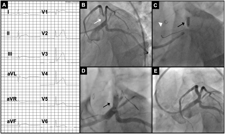 (A) Twelve-channel electrocardiogram showing distinct ST-segment elevation in the precordial leads and in II, III, and aVF. (B–E) Coronary angiography (left anterior oblique caudal projection) indicating subtotal stenosis of the left anterior descending artery (white arrow in B). Using a FilterWire EZ™-system (Boston Scientific, Marlborough, MA, USA) to protect the peripheral vessels (white arrowhead in C) dilatation and drug-eluting stent implantation (black arrow in C and D) were performed to recover blood flow (E). A guide wire was placed in the first diagonal branch for sidebranch protection. The left circumflex artery and the right coronary artery (not shown) were normal in angiographic appearance.