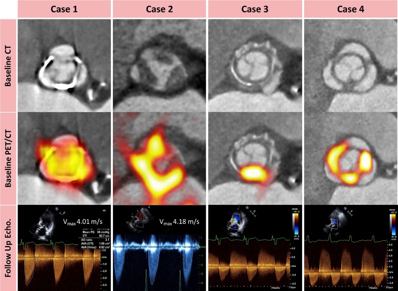 18F-fluoride positron emission tomography and computed tomography predicting deterioration in bioprosthetic valve function. Cases 1-4 depict the role of 18F-fluoride positron emission tomography (PET) and computed tomography (CT) in predicting new bioprosthetic valve dysfunction. None of the patients had known bioprosthetic degeneration at enrolment. Contrast-enhanced CT images in the short axis of the valve (top row) show no clear structural CT changes in case 1, non-calcific leaflet thickening in case 2 and circumferential pannus in cases 3 and 4. Hybrid 18F-fluoride PET-CT images (middle row) show high intensity 18F-fluoride uptake in each valve. Doppler echocardiography (bottom row) shows the development of new valve dysfunction during follow-up with progression to hemodynamically severe stenosis in cases 1 and 2, and new prosthetic regurgitation in cases 3 and 4. Image courtesy of T. Cartridge
