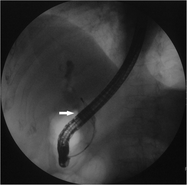 A repeated ERCP revealed a dilated common bile duct with a long filling defect. (arrow)