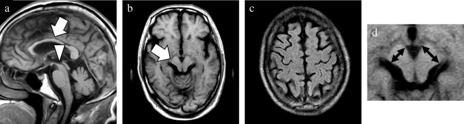 A representative case of CBD mimics. This 71-year-old male patient obtained a postmortem diagnosis of PSP. MRI was performed two years after the symptom onset. Sagittal and axial T1WI (a, b), and axial FLAIR image (c) showed atrophy of the midbrain and callosal body (arrow and arrowhead, a), and right dominant asymmetric atrophy of the cerebral peduncle without obvious SWMH (arrow, b). These MRI findings were very similar to those of the patient described in Fig. 6. The case of this patient was exhibited to clarify the challenges when differentiating CBD without SWMH from its mimics, especially PSP. A magnified view was exhibited to emphasize the asymmetry of the short axis in the cerebral peduncles (double sided arrows, d). a, sagittal T1WI; b, axial T1WI; c, axial FLAIR image; CBD, corticobasal degeneration; FLAIR, fluid attenuated inversion recovery; PSP, progressive supranuclear palsy; SWMH, subcortical white matter hyperintensity; T1WI, T1-weighted image