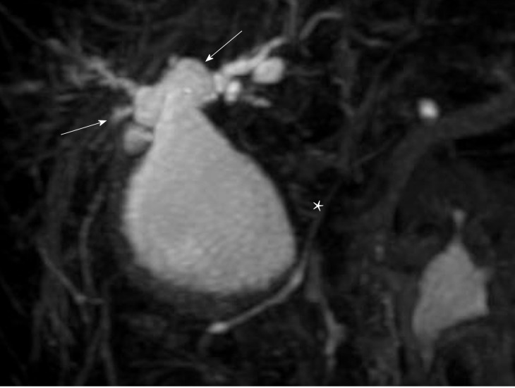 3D-reconstruction of magnetic resonance cholangiopancreatography shows an abnormally dilated common bile duct (white star). Both right and left hepatic ducts also show intrahepatic dilatations (white arrows).