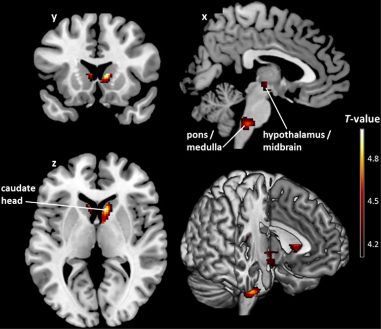 Brain regions where cannabinoid 1 receptor (CB1R) availability covaries negatively with log body mass index (BMI) in healthy controls. T map of significant negative correlations between CB1R availability and log BMI in predefined homeostatic and reward-related regions of interest shown at a threshold of PFWE-corrected<0.05 (both at the voxel- and cluster-level; n=26). The colored voxel-based statistical parametric mapping (SPM) results of the negative correlations in sagittal (x), coronal (y) and transverse (z) sections are overlaid on a normalized canonical image (ch2better-template) available in MRICron software. The color bar expresses T-score levels.