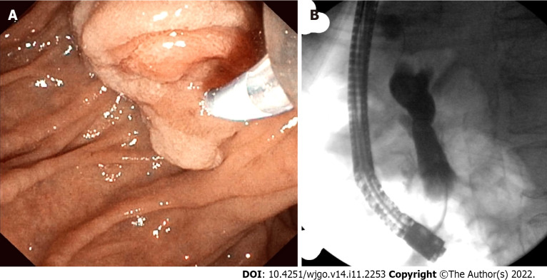 Endoscopic retrograde pancreatography studies. A: The patient had abnormal papilla with a polypoid mass. Sphincterotomy and deep cannulation procedures were performed and confirmed by fluoroscopy. endoscopic retrograde cholangiopancreatography (ERCP) showed common bile duct (CBD) dilatation, and there was an abrupt cutoff at the distal aspect; B: ERCP fluoroscopy. Fluoroscopy showed CBD dilatation, and there was an abrupt cutoff at the distal aspect.