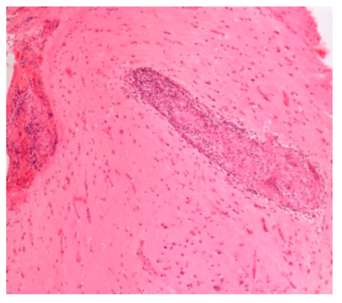 Neurosarcoidosis. H&E. Magnification 100×.