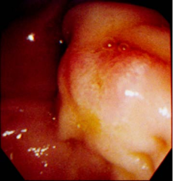 Endoscopy shows a slightly enlarged ampullary region, suggesting the existence of a submucosal tumor because the epithelium has a normal appearance.
