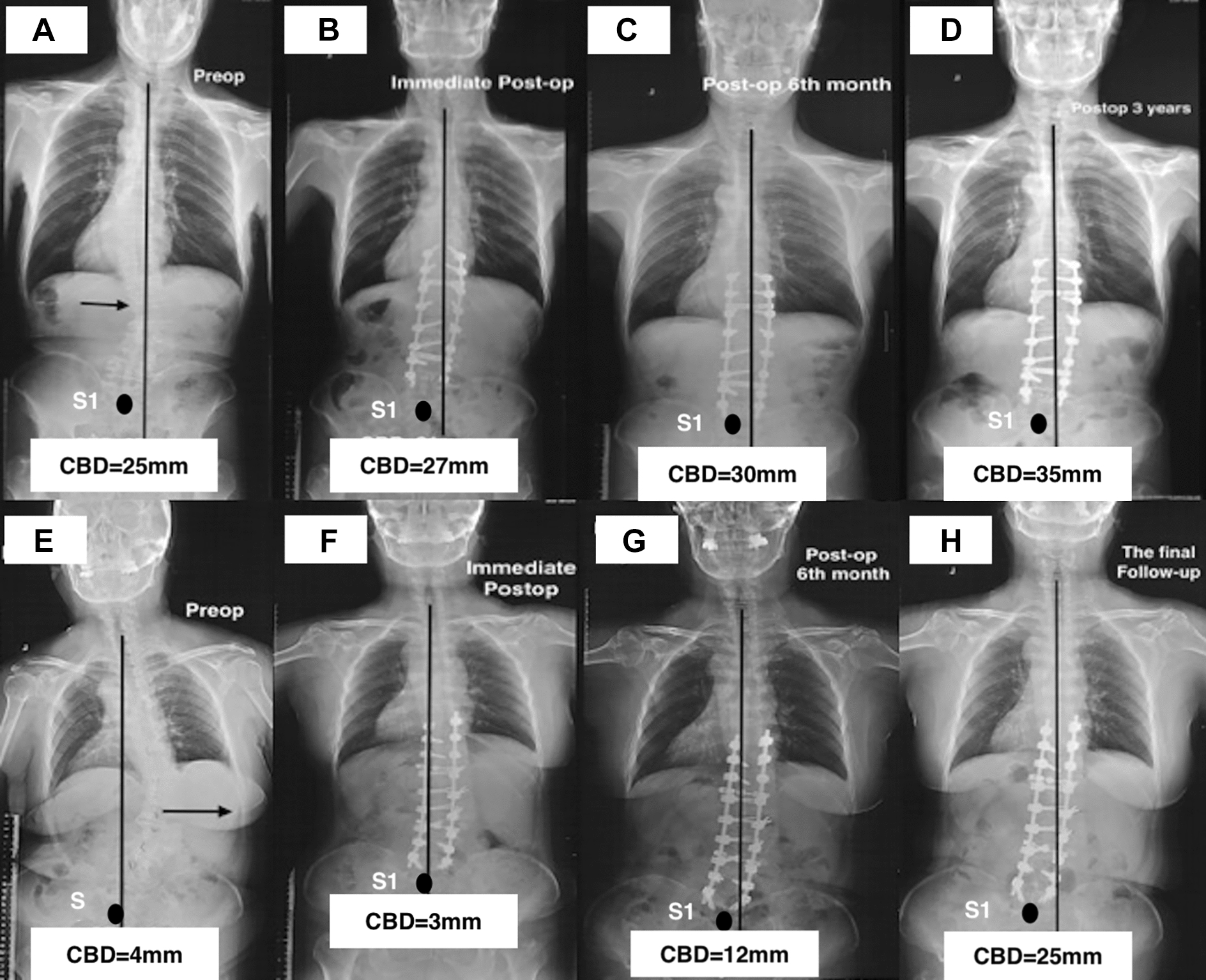 A 61-year-old female ASD patient with consistency alignment had a CBD of 25 mm pre-operatively (A), 31 mm immediately (B), 30 mm (C) and 35 mm (D) at 6th month and the final follow-up postoperatively. A 68-year-old female ASD patient with opposition coronal alignment had a CBD of 4 mm preoperatively (E), 3 mm immediately (F), 12 mm (G) and 25 mm (H) at 6th month and the final follow-up postoperatively
