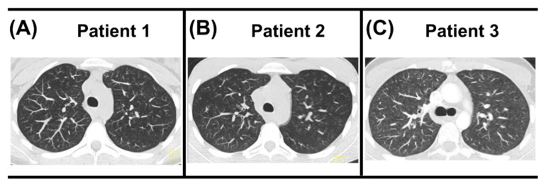 CT follow-up. (A) Follow-up CT of Patient 1 after 6 months showed near complete resolution of the previously extensive tree-in-bud pattern. (B) Follow-up CT of Patient 2 after 35 months showed no tree-in-bud pattern but centrilobular nodular hazy densities with upper lobe predominance suspicious for respiratory bronchiolitis disease, possibly secondary to inhaled noxae. (C) Follow-up CT of Patient 3 after two months showed significant improvement. Due to the recent manifestation, no follow-up CT of Patient 4 was currently available.