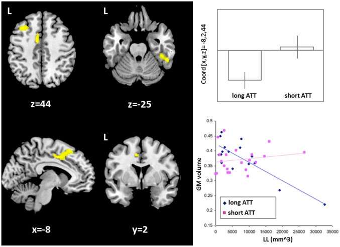 Interaction between the CNR1 genotype and T2-weighted lesion loads on regional GM volumes.In yellow, there are shown those areas (i.e., left frontal and cingulate cortex, and right temporal cortex) in which an inverse correlation exists between T2-lesion load and local grey matter volumes in individuals with long AAT repeats, but that is absent in those with short AAT repeats. The plot on the top right shows this effect of interaction in the left frontal and cingulate area. This same effect is also confirmed, on a subject by subject basis, by the sctatterplot on the bottom right. Statistical threshold: p values FWE-corrected <0.05. Spatial coordinates (x,y,z) in the figure are in MNI space. Abbreviations: LL = T2-weighted lesion load; GM = grey matter.