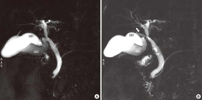 Magnetic resonance choledochopancreatography reveals V-shpaed duplicated GB with right hepatic duct anomaly. (A) GB 1 was inserted into the neck of the other GB (GB 2). (B) The right posterior bile duct (arrow) joined the CBD near the common cystic duct.GB = gallbladder, CBD = common bile duct.