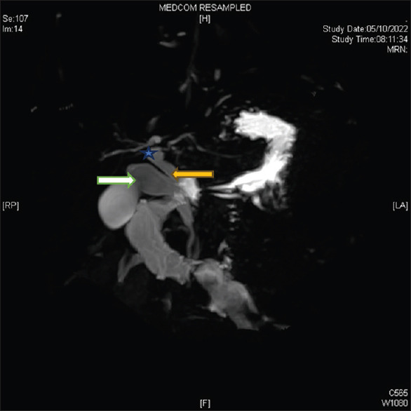 Magnetic resonance cholangiopancreatography reconstruction image showing dilated cystic duct 10 mm (white arrow) and common bile duct 7.5 mm (yellow arrow), common hepatic duct (star)