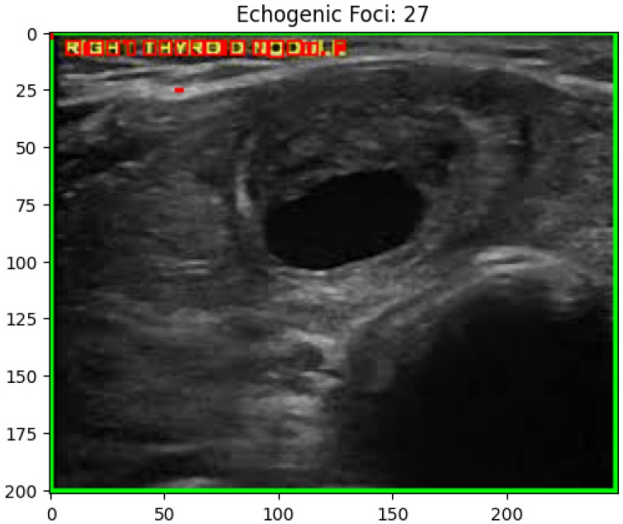 Echogenic foci Detection