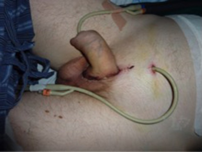 Continued wound healing following removal of drains.