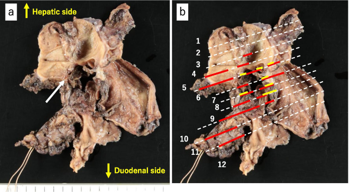 Macroscopic findings of the resected specimen of extrahepatic bile duct. a Suspected bleeding site with blood clot, severe inflammation, and existence of embolic material (solid white arrow). b A white dotted line with serial number is secant line for pathological examinations. Red lines indicate hemorrhagic area, and a yellow line indicates carcinoma area