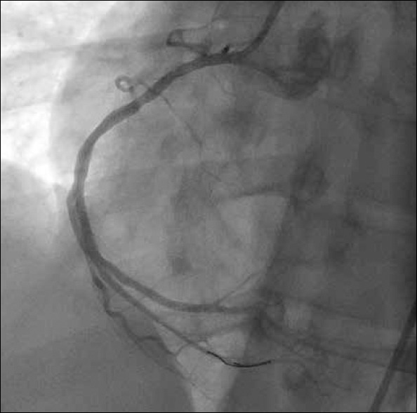 RCA angiography after primary percutaneous coronary intervention in the left anterior oblique position