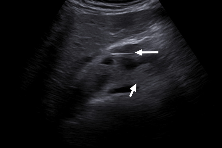 Doppler ultrasound image demonstrating the intrahepatic bile duct with a biliary catheter in situ (white arrow)The catheter appears as an echogenic linear structure within the common bile duct (CBD), confirming appropriate placement following endoscopic retrograde cholangiopancreatography (ERCP)