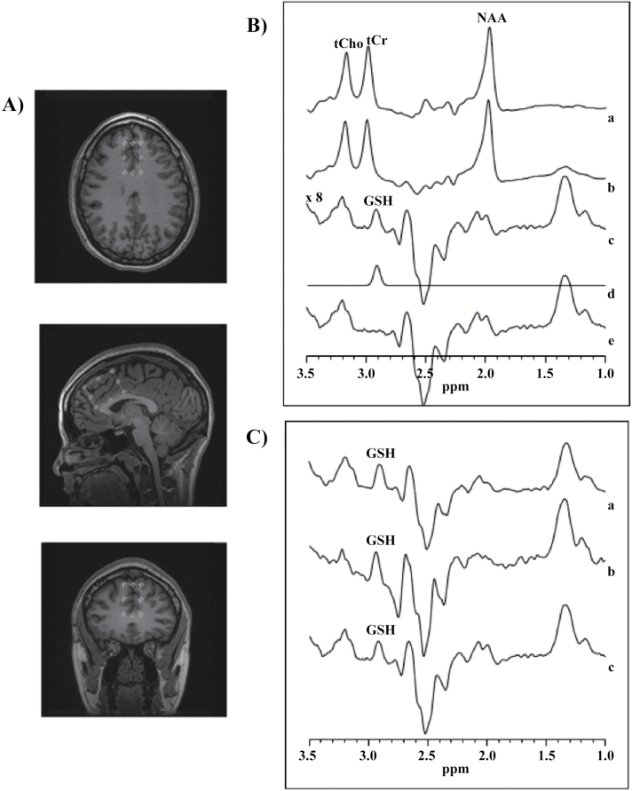 (A) Axial, sagittal, and coronal views of the voxel placement in the medial prefrontal cortex (mPFC). (B) Typical fitting results from a patient, (a) 1H-MRS subspectra acquired for the “on” condition (see text), (b) “off” condition, (c) subtracted to obtain clean glutathione (GSH) resonance at 2.9 ppm, (d) frequency domain model-fitting of edited GSH resonance only, and (e) residual of the difference between c and d. (C) Representation of the subtracted subspectra from 3 subjects.