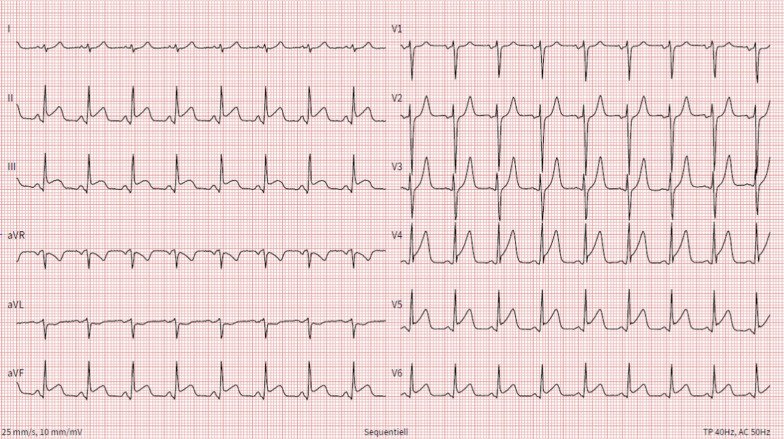 ECG at hospital admission. ECG = electrocardiogram