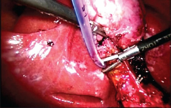 Intra-operative cholangiography being performed using catheter