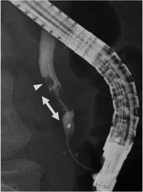 ERCP revealed a circumferential stenosis 11.8 mm distal from the ampulla of Vater (double arrow), and a 5.1 × 6.5-mm irregular-shaped elevated lesion (arrowhead) of the DBD